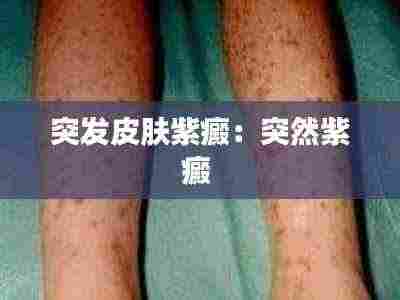 突发皮肤紫癜：突然紫癜 