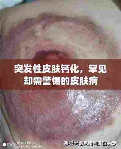 突发性皮肤钙化,罕见却需警惕的皮肤病